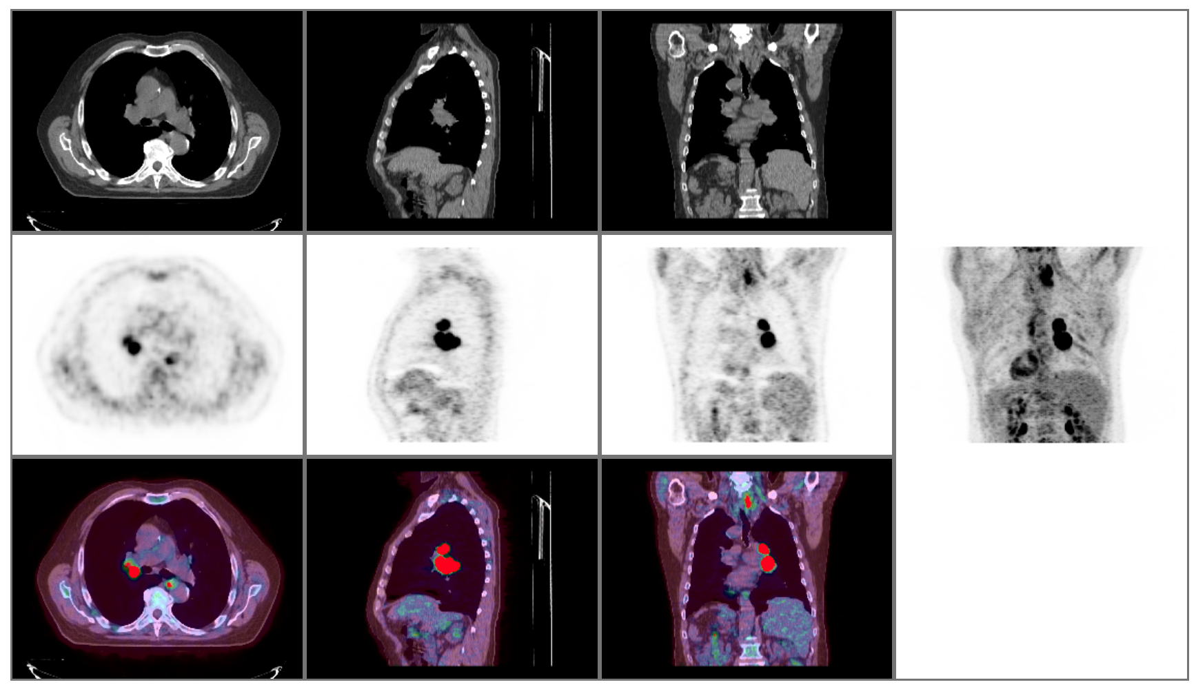 A Complex PET-CT Fusion Layout Involving 10 Viewports