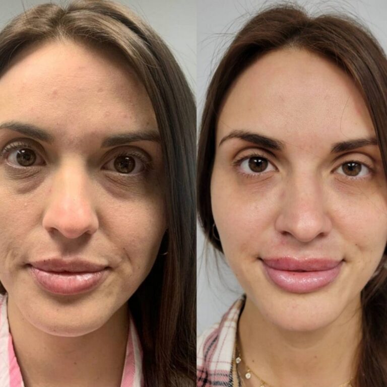 Before & After Gallery Juliet Lee, MD Aesthetics