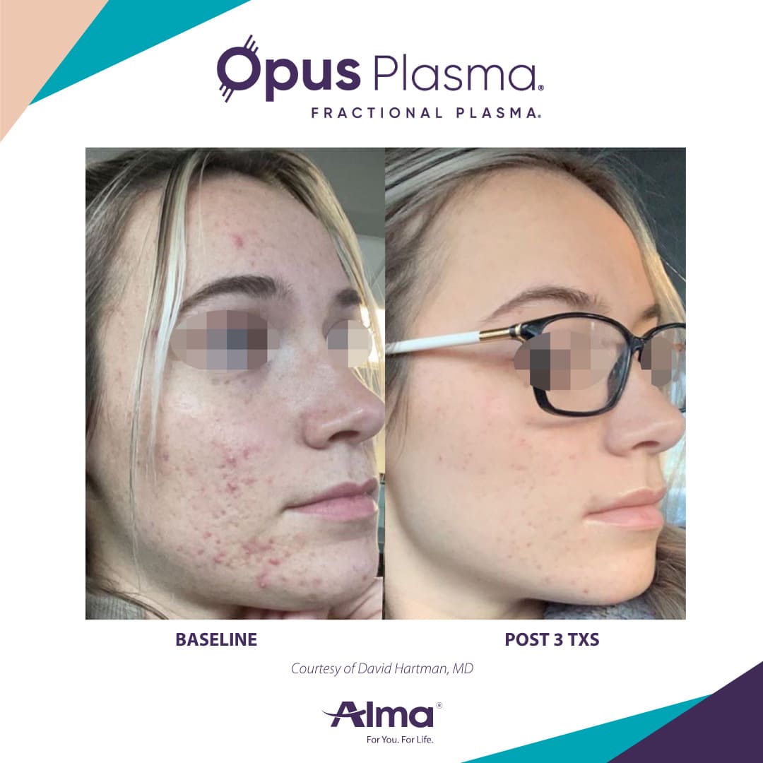 Opus Plasma Patient 1