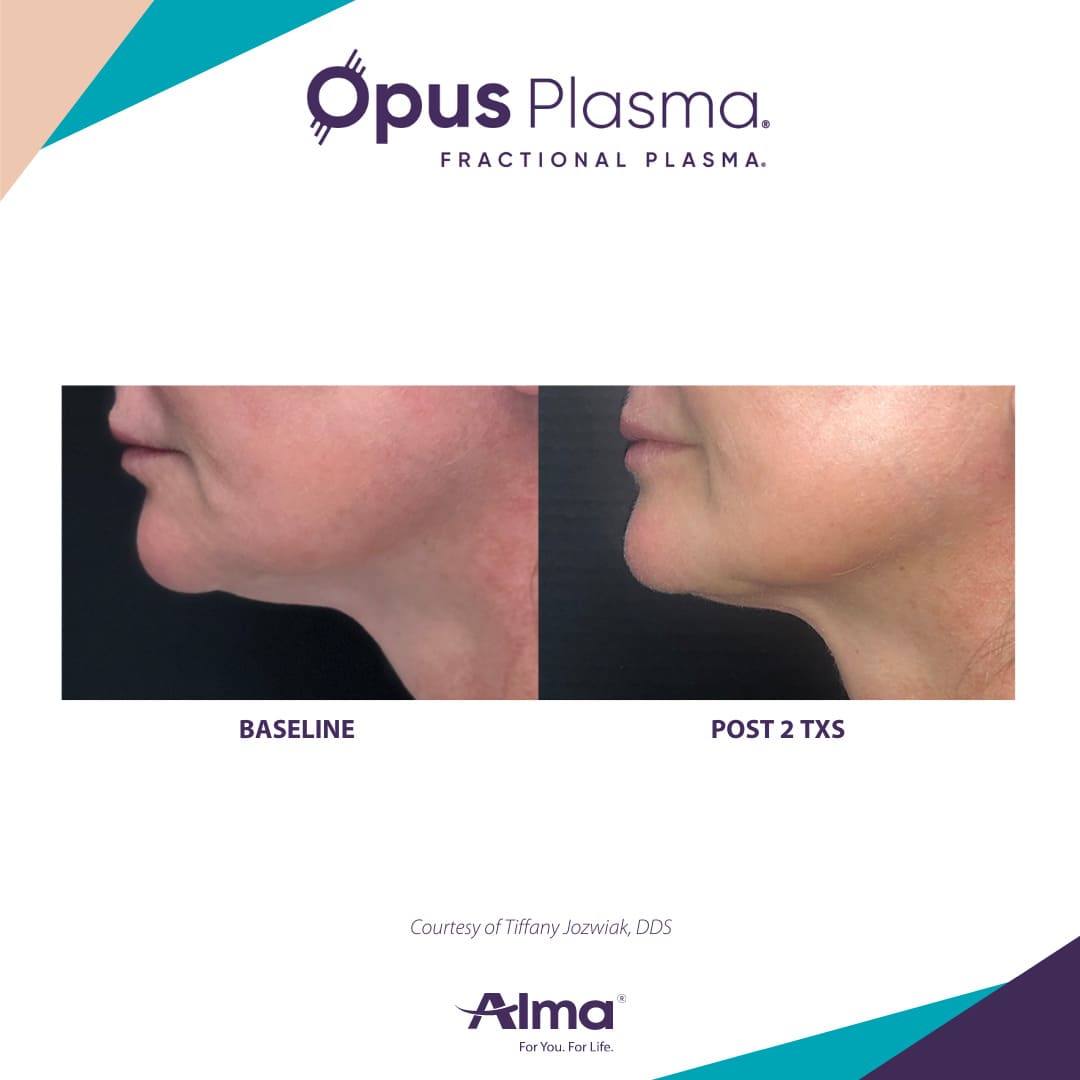 Opus Plasma Patient 5