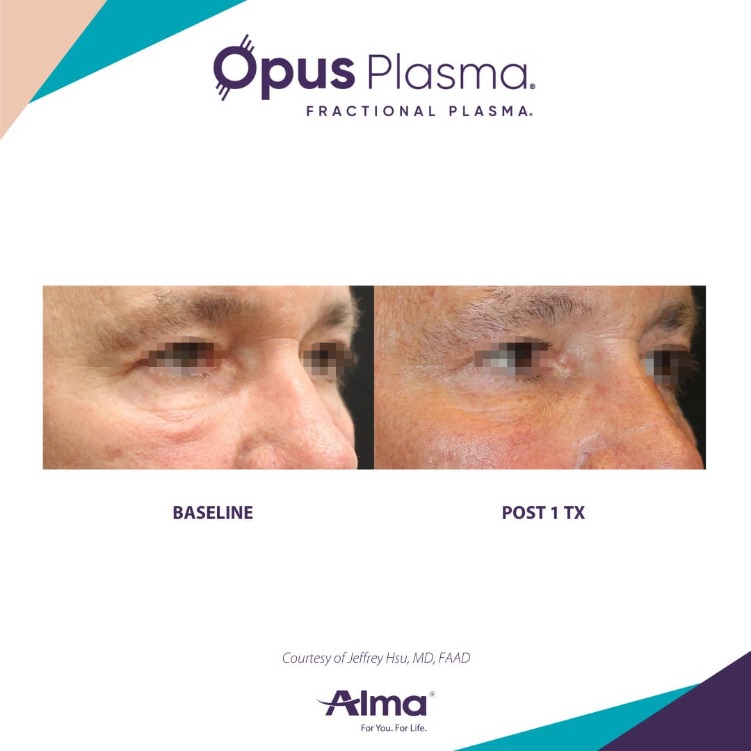 Opus Plasma Patient 2