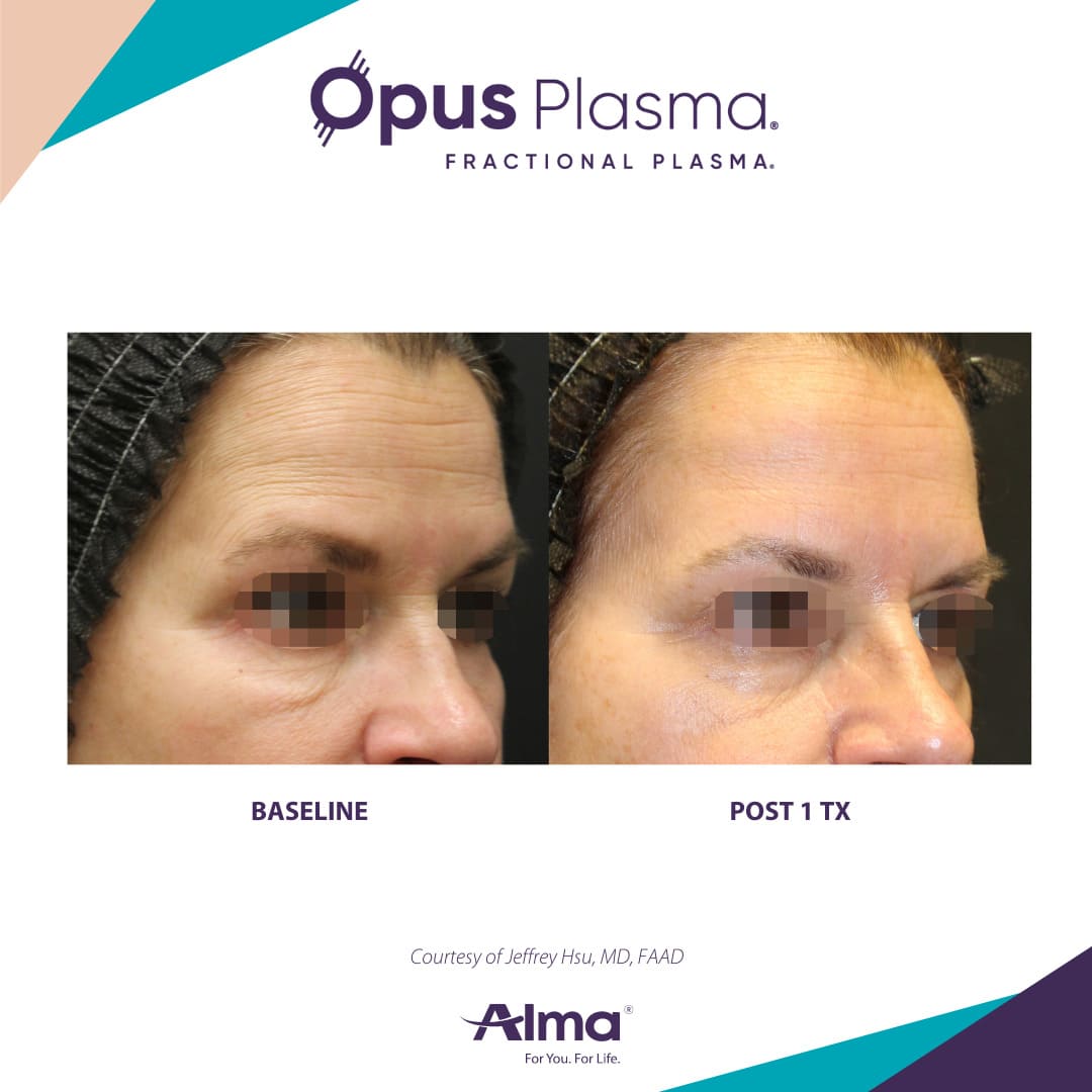 Opus Plasma Patient 3
