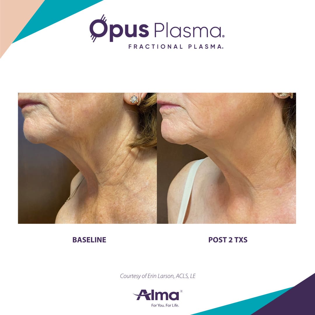 Opus Plasma Patient 4