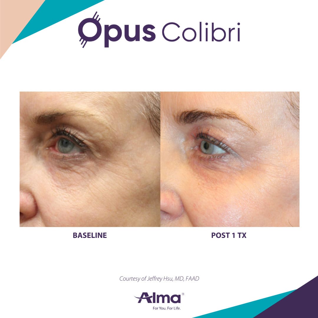 Opus Plasma Patient 6