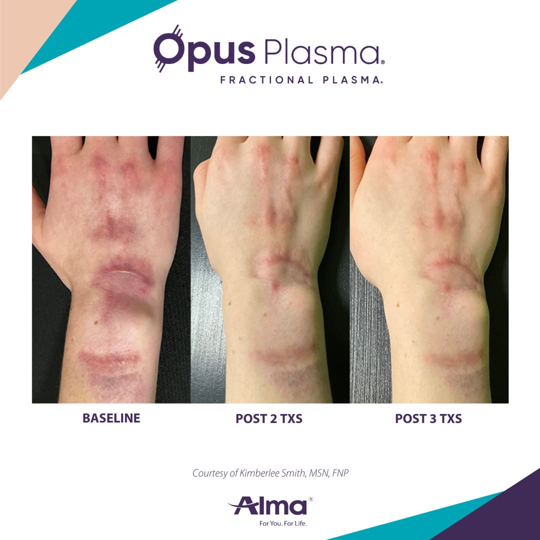 Opus Plasma Patient 7
