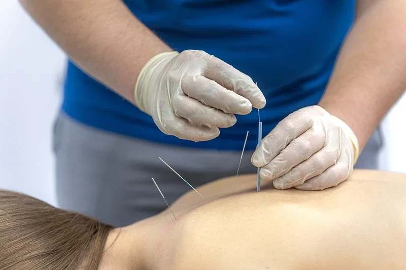 Ședință de acupunctură pentru controlul durerii oncologice
