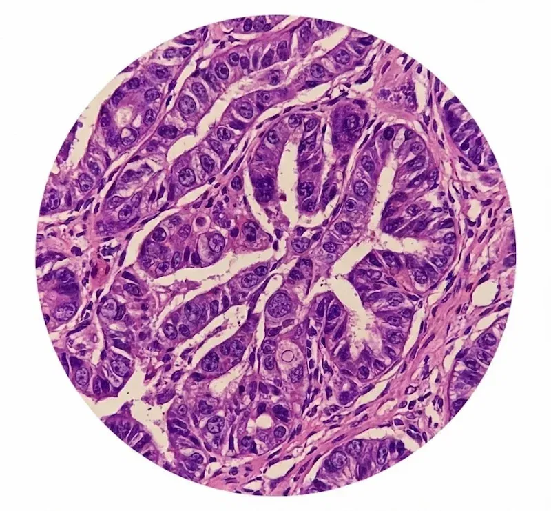 Imagine microscopică a unui adenocarcinom, ilustrând structura neregulată a celulelor glandulare maligne și organizarea haotică a țesutului tumoral