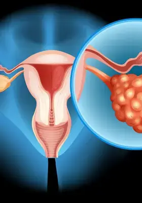 Ilustrație medicală a ovarului – asociată scorului ROMA și riscului de cancer ovarian